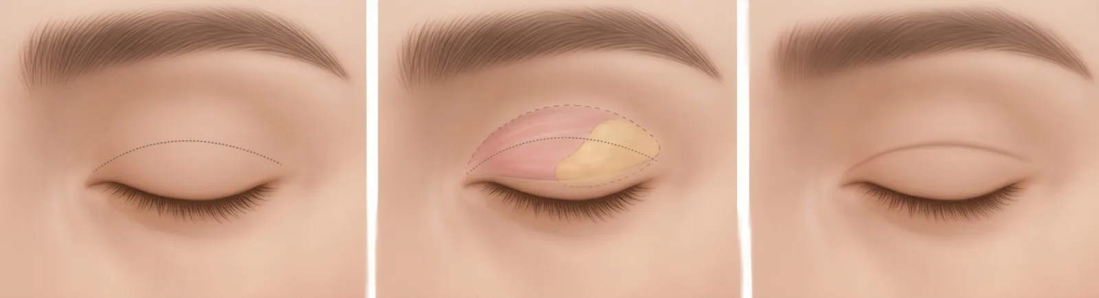 Illustrated steps of incision double eyelid at Garnet: crease line marked, muscle and fat tissue beneath the line, and the healed crease