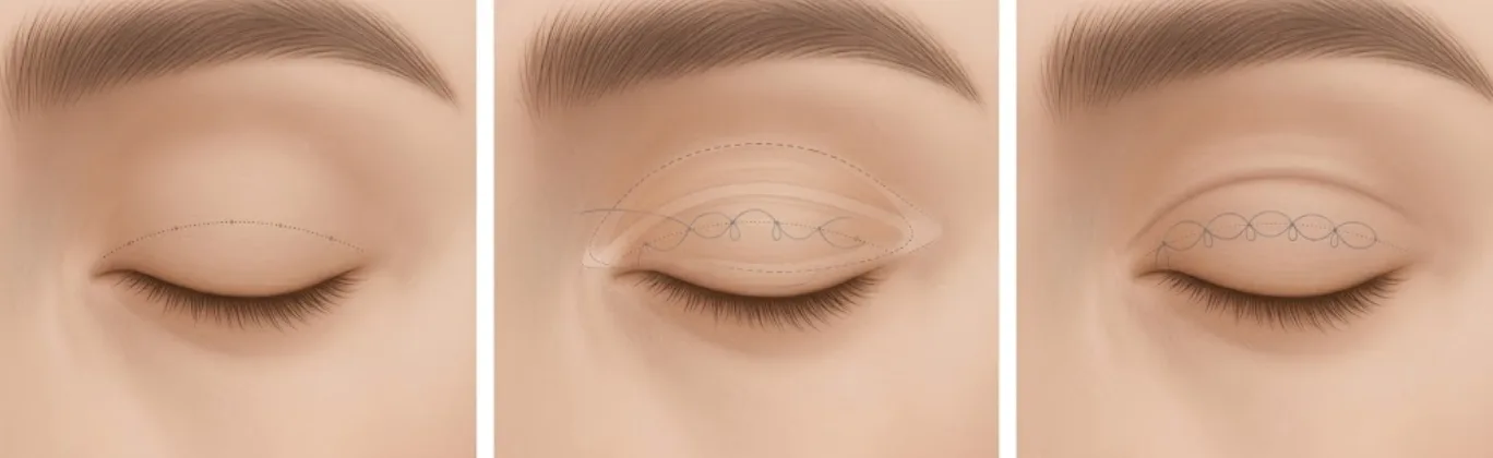 Illustrated steps of non-incision double eyelid at Garnet: crease line marked and a buried suture loop forming the fold with no skin incision
