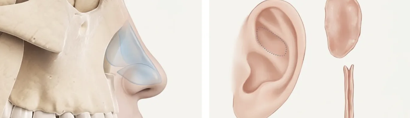 Illustration of cartilage graft sources for rhinoplasty at Garnet: the nasal septum inside the nose and the cartilage of the ear